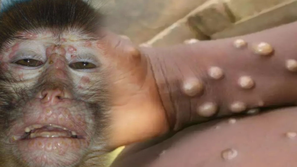 Maymun çiçeği salgını durdurulamıyor: Tüm kıtada acil durum ilan edildi!