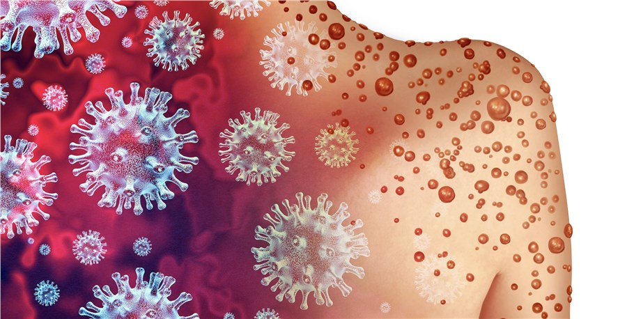 Maymun çiçeği salgını durdurulamıyor: Tüm kıtada acil durum ilan edildi!