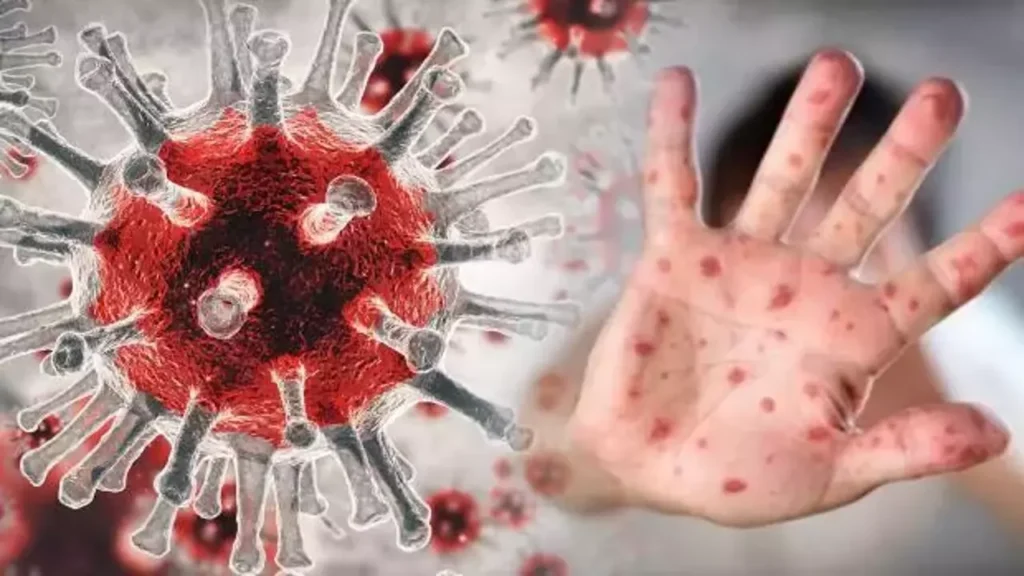 Maymun çiçeği salgını durdurulamıyor: Tüm kıtada acil durum ilan edildi!